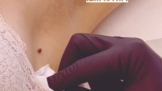 Odstranjevanje izrastka