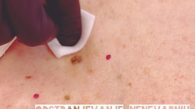 Odstranjevanje starostnih bradavic