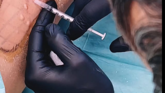 Zdravljenje prekomernega potenja