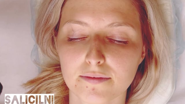 Salicilni piling za akne