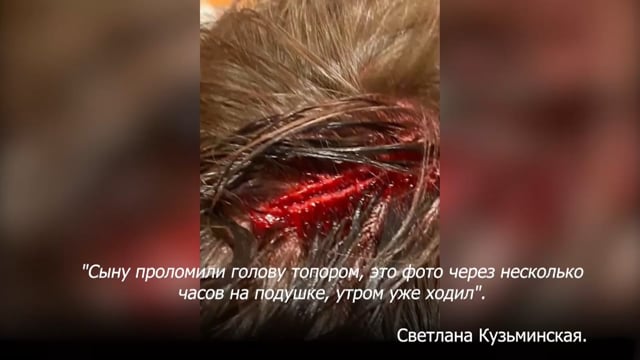 Удар топором в голову. Невероятный результат быстрого заживления.