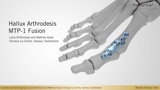 APTUS Foot Hallux System 2.8 - Hallux Arthrodesis MTP 1 Fusion