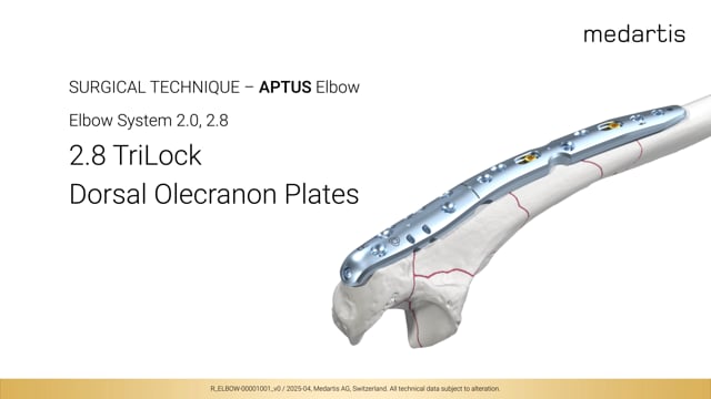 Animated Surgical Procedure – Dorsal Olecranon System 2.8