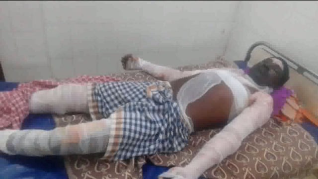  आनंदपुर थाना क्षेत्र के भोरसार गांव में दुकानदार द्वारा पेट्रोल भरने की लापरवाही से बुरी तरह झुलसे ग्रामीण  