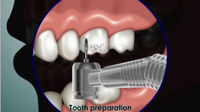 testimonial-3 patient-Crowns