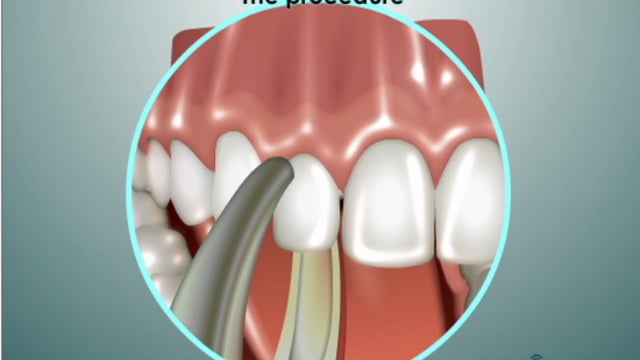 testimonial-4 patient-Extractions
