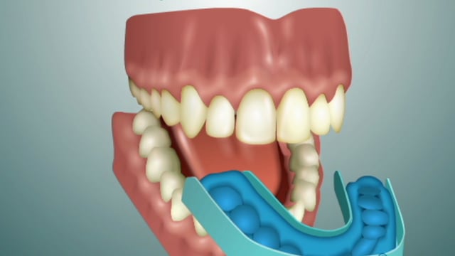 testimonial-6 patient-Home Tooth Whitening