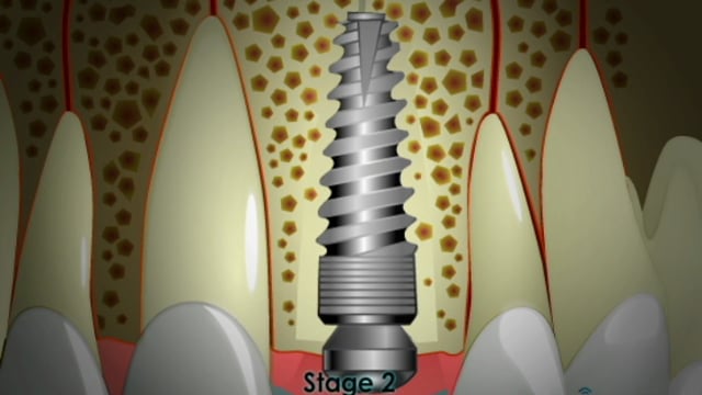 testimonial-7 patient-Implants