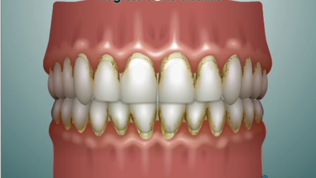 testimonial-8 patient-Periodontal Disease
