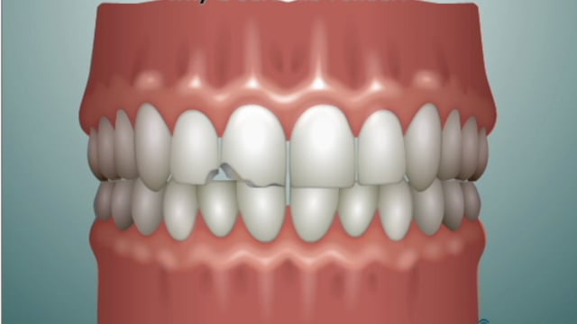 testimonial-9 patient-Veneers 