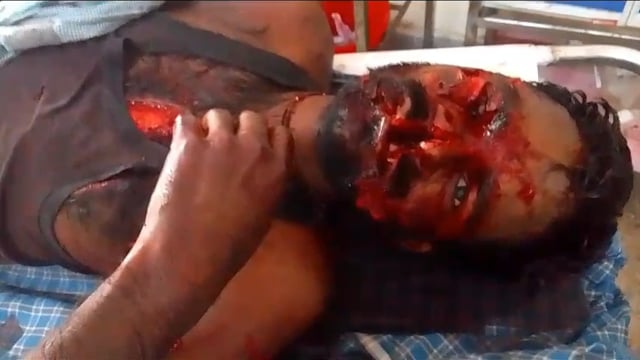 नरकटी जंगल में बकरी चराने गए युवक पर भालू ने किया हमला, हालत गंभीर ट्रामा सेंटर रेफर