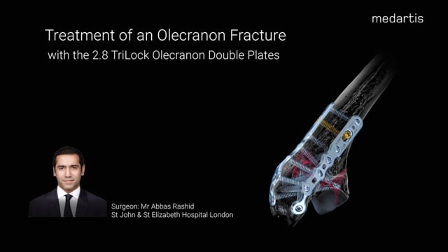 Treatment of an Olecranon Fracture with the 2.8 TriLock Olecranon Double Plates