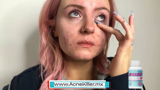Acne Solution Video