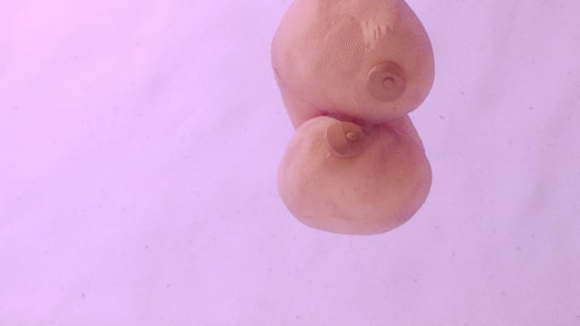 Breast Cancer Awareness