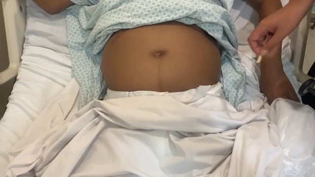 Exame Neurológico: Dissociação abdominal