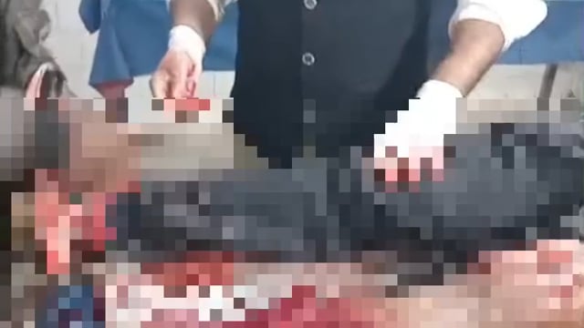 हाईवा की टक्कर से बाइक सवार युवक गंभीर रूप से जख्मी, पटना रेफर