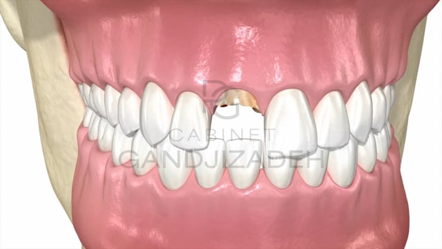 Extraction implantation immédiate