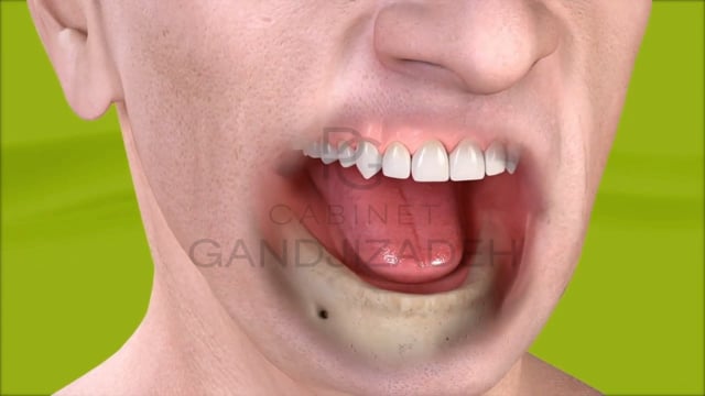 Prothèse amovible sur implant