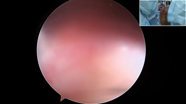 Arthroscopic RC Repair with Lower TRAP Transfer