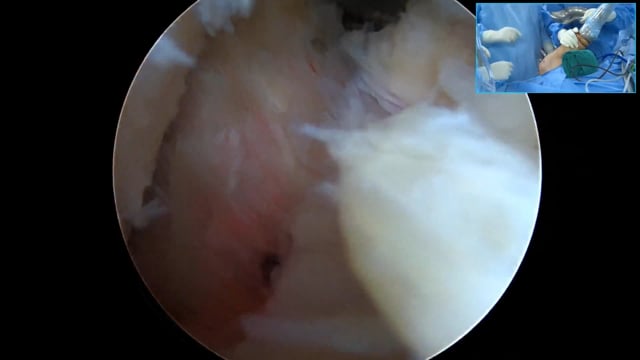 Biopatch Augmentation of RC Repair