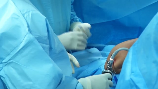 Balloon Spacer for Massive Cuff Tear
