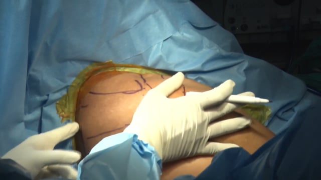 Muscle Slide for Massive Cuff Tear