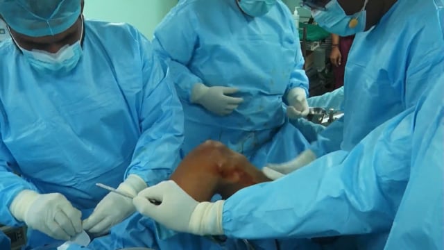 ACL Reconstruction