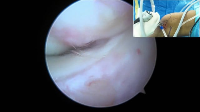Arthroscopic PLC Reconstruction