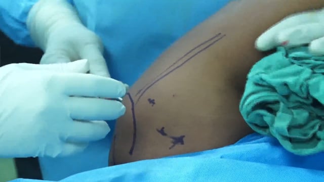 Arthroscopic Bankart + Remplissage + Bone Block Augmentation