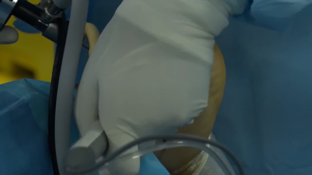 Posterior Ankle Instability (PAI)