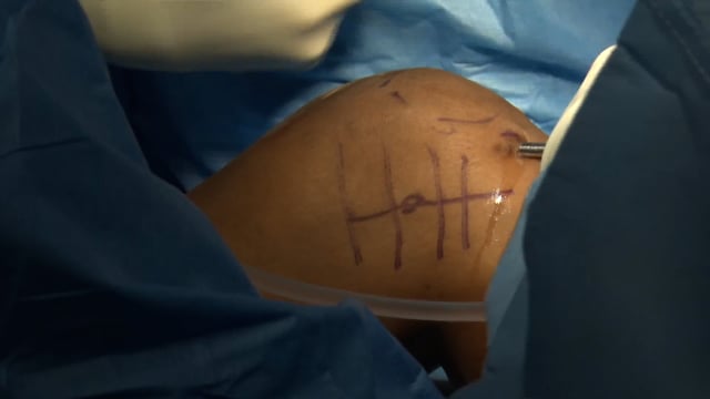Revision ACL with Lemaire