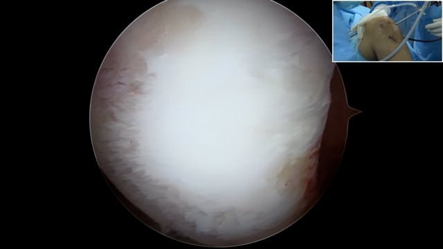 Autograft Chondral Defect Knee