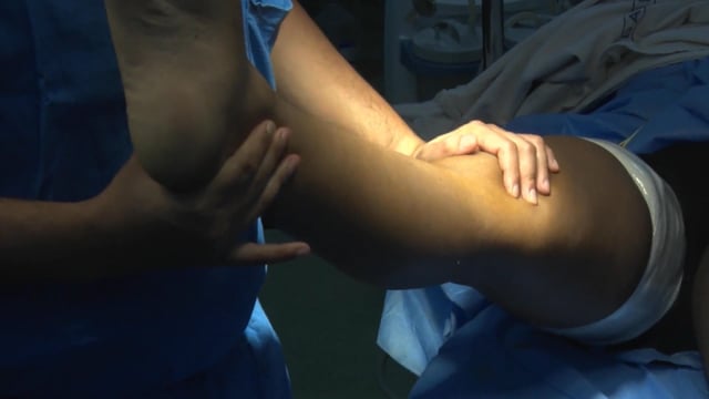 Double Bundle ACL