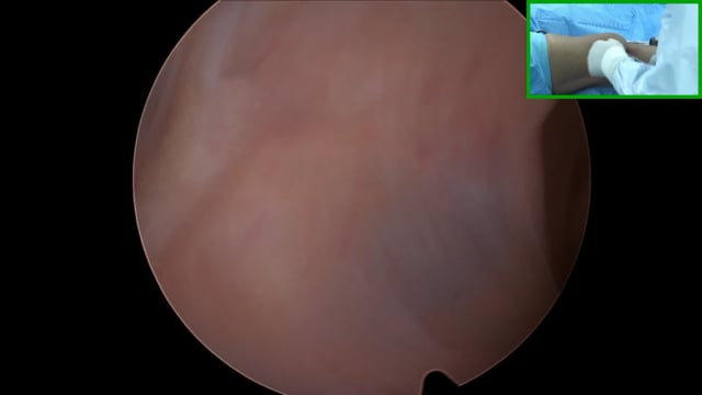 MPFL Reconstruction