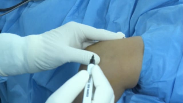 Arthroscopic Tennis Elbow Release