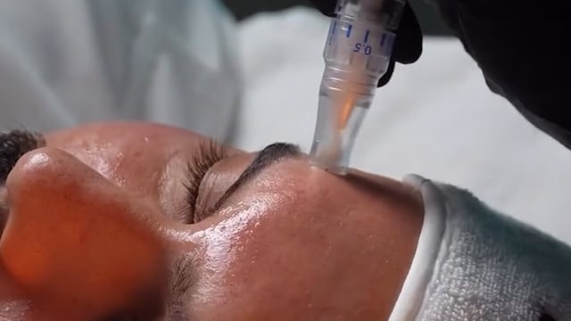 Excellage treatment preview