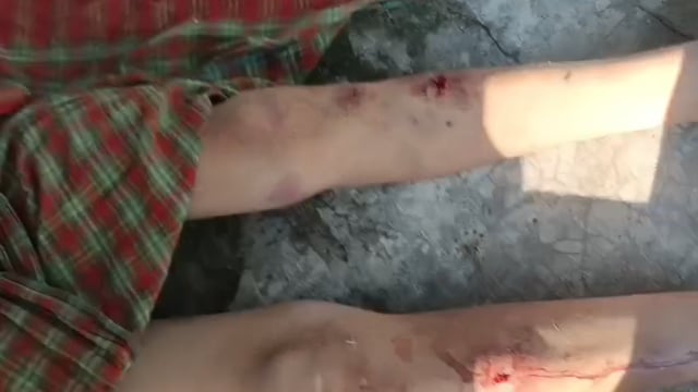 राजेसुल्तानपुर में दरिंदगी की इंतेहा 12 साल के मासूम को बंधक बनाकर पैर में घोंपा भाला, सिगरेट से दागा