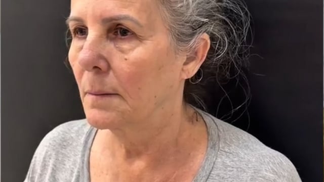 Depoimento — Resultado rejuvenescedor