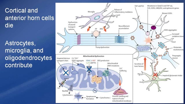 Why do people get ALS? Epidemiological studies to find answers Screen Grab