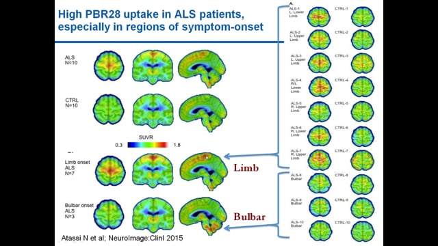 Ibudilast trials in ALS Screen Grab