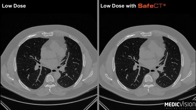 Low-Dose CT Lung Screening logo
