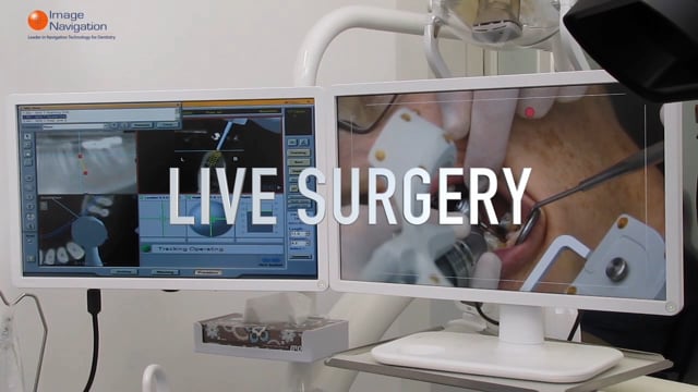 IGI 2.0 dental implant surgery Dr. Uri June 2022 (1 min highlights). By Image Navigation. logo logo logo