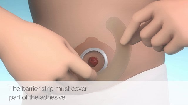 Product video: Brava Elastic Barrier Strips by Coloplast - Straight, Curved & Y-Shape
