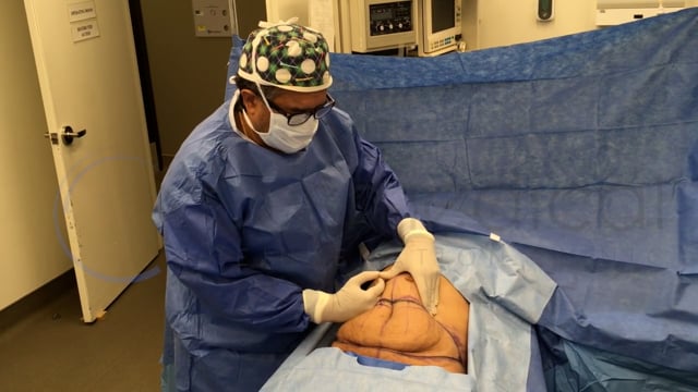 Hourglass Tummy Tuck Procedure - Patient 2