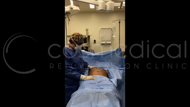 Fat Transfer Breast Augmentation Toronto