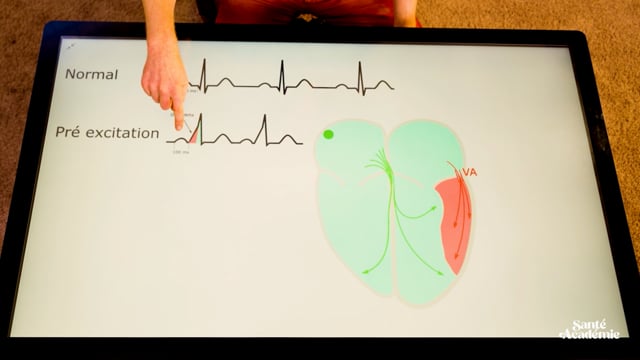Lecture et interprétation de l’électrocardiogramme (ECG)