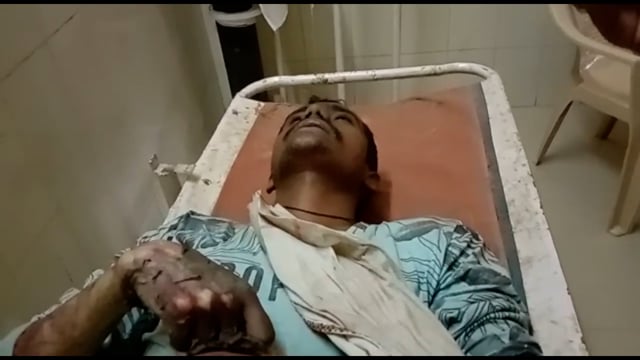 टिकरी कला गांव में दिमागी संतुलन ठीक नहीं होने के कारण युवक ट्रांसफार्मर से चिपक कर झुलसा,जिला अस्पताल में इलाज जारी