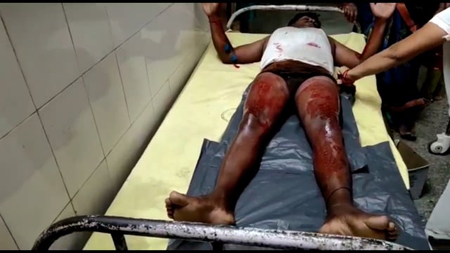 शरीर पर गर्म दूध गिरने के कारण एक ब्यक्ति गंभीर रूप से हुआ घायल