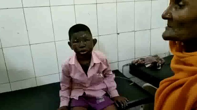 रामगढ़ में खेल खेल में बारूद की पोटली में लगी आग, मासूम झुलसा