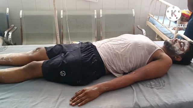 नगर परिषद क्षेत्र के थाना मोड़ के समीप एक चाय की दुकान में काम करने के दौरान गर्म दूध में गिरने से दुकानदार बुरी तरह झुल